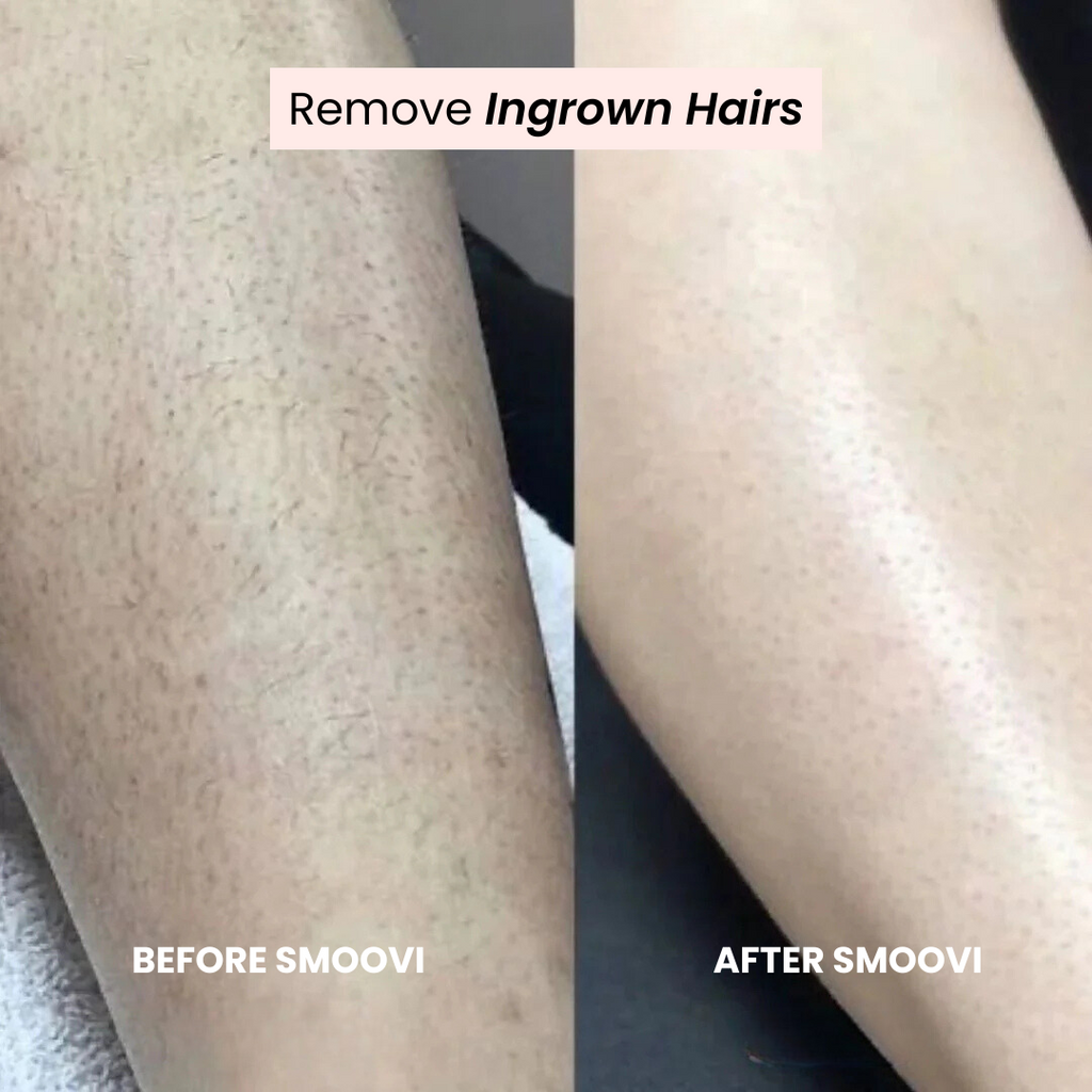 Before and after comparison of ingrown hairs using the product.