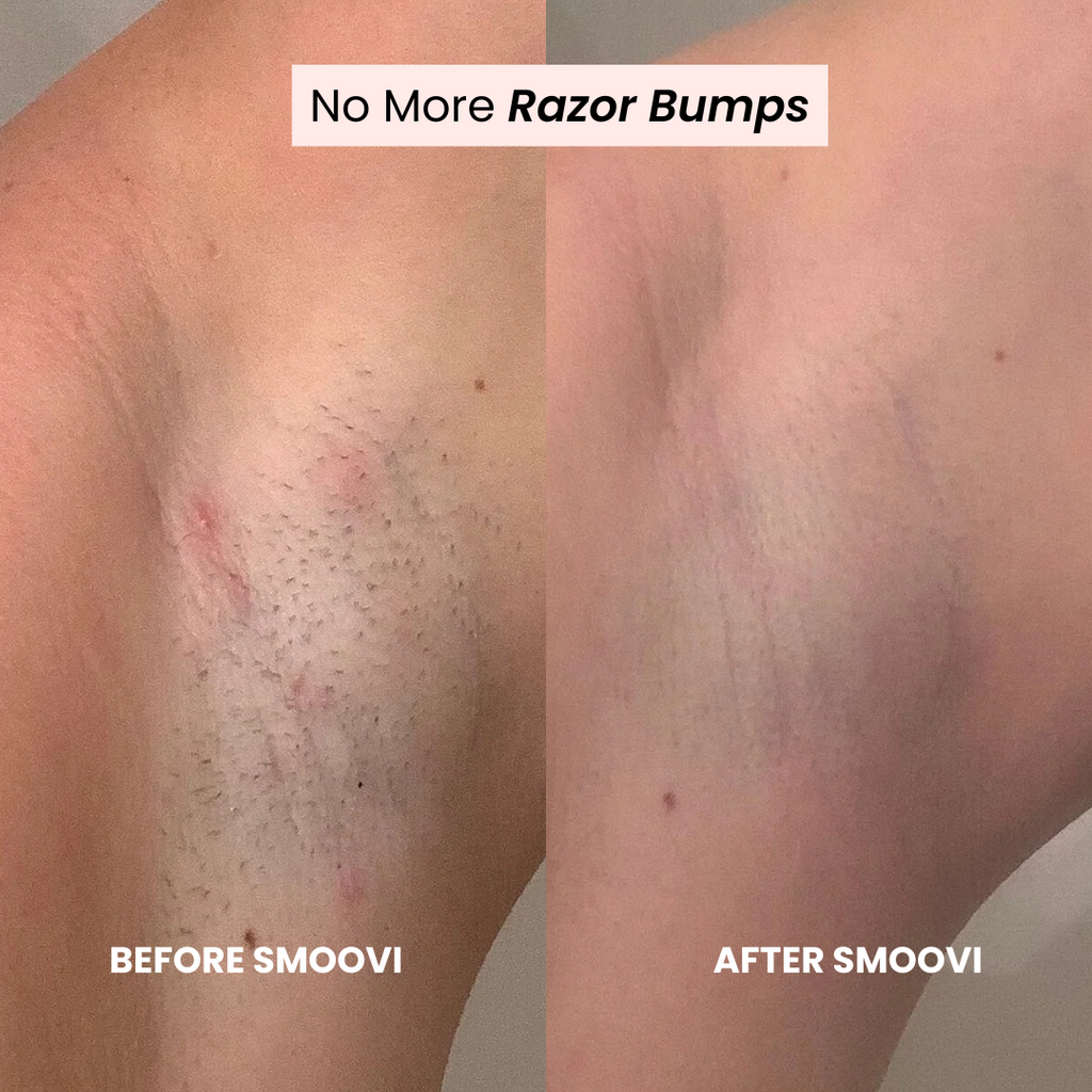 Comparison of razor bumps before and after using on a person's leg.